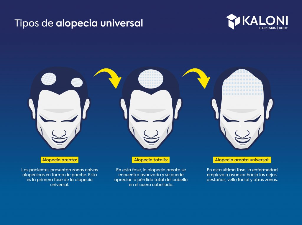 ¿Cuáles son los tipos de alopecia universal?