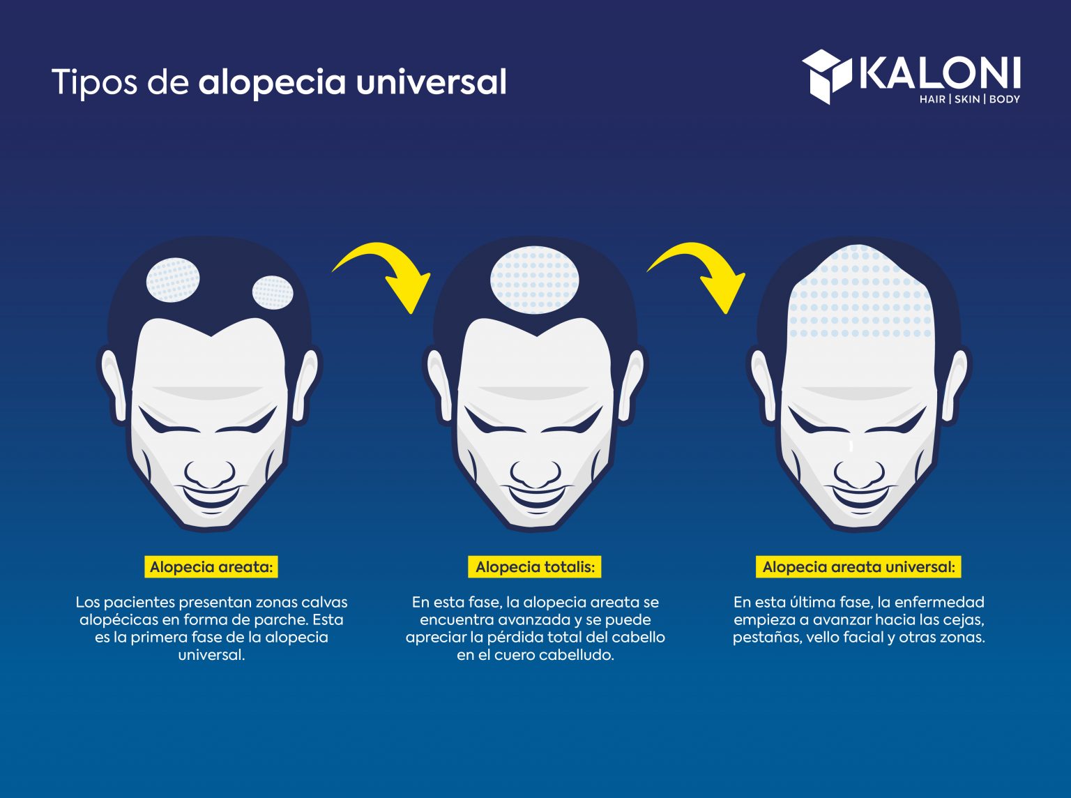 Alopecia Universal. Síntomas Y Tratamientos. Costo Y Precio.