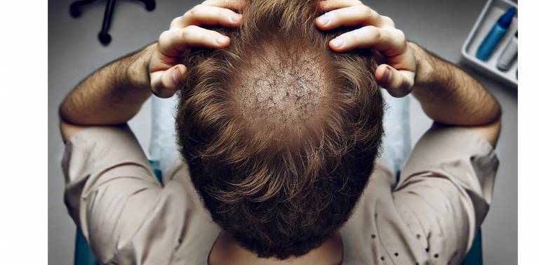 Trasplante de Cabello Precio