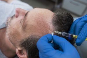 Cuánto cuesta el injerto de pelo