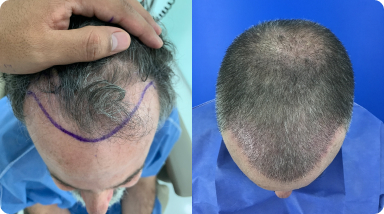 cuanto cuesta un trasplante de cabello