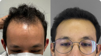 2000 grafts hair transplant cost usa