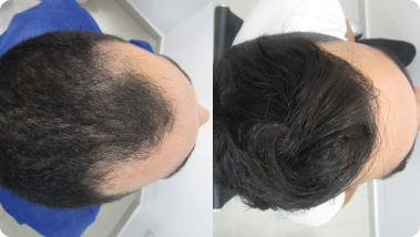 how much is hair transplant in usa