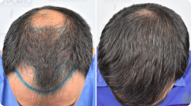 hair transplant cost turkey vs usa