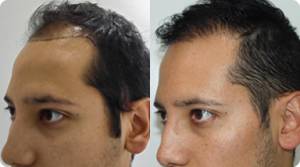 trasplante de pelo precio