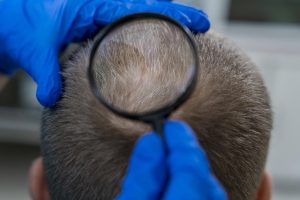 injerto de pelo en turquía