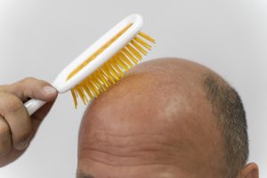 Costo del injerto de pelo