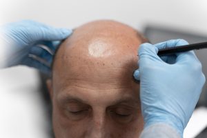 cuánto vale el injerto de pelo