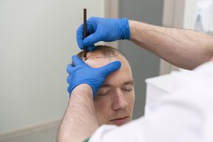 proceso de injerto de pelo