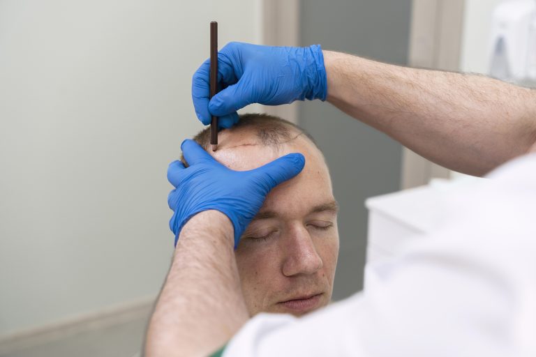 proceso de injerto de pelo