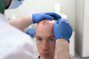 Trasplante de pelo en Clínica
