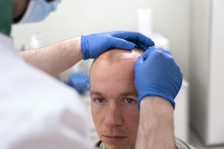 Trasplante de pelo en Clínica